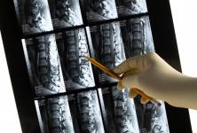 Boj proti osteoropóze