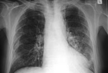 Tuberkulóza – hrozí nám její návrat?