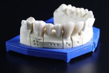 Jak pečovat o zubní náhradu?