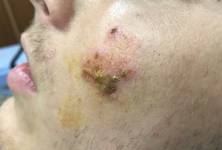Impetigo - bakteriální infekce postihující kůži 
