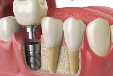 Zubní implantáty – z čeho se vyrábí, kolik stojí a jak o ně pečovat? 