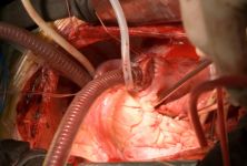 Iinfarkt - ischemická choroba srdeční 
