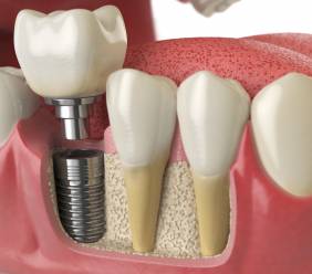 Zubní implantáty – z čeho se vyrábí, kolik stojí a jak o ně pečovat? 